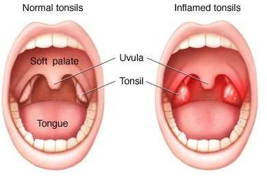 Enlarged Tonsils in Children