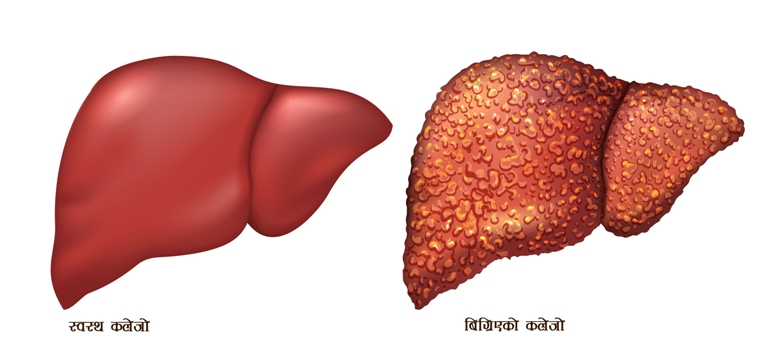 healthy-liver-bad-liver